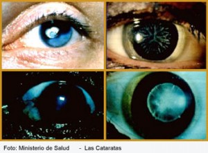 cataratas-foto-minsa-copia