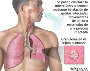 Tuberculosis, enfermedad, epidemia, vias respiratorias - noticias